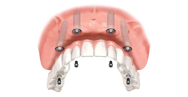 Implantologia dentale Lecco Merate