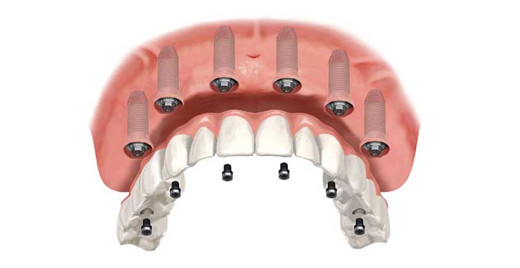 Implantologia dentale Lecco Merate